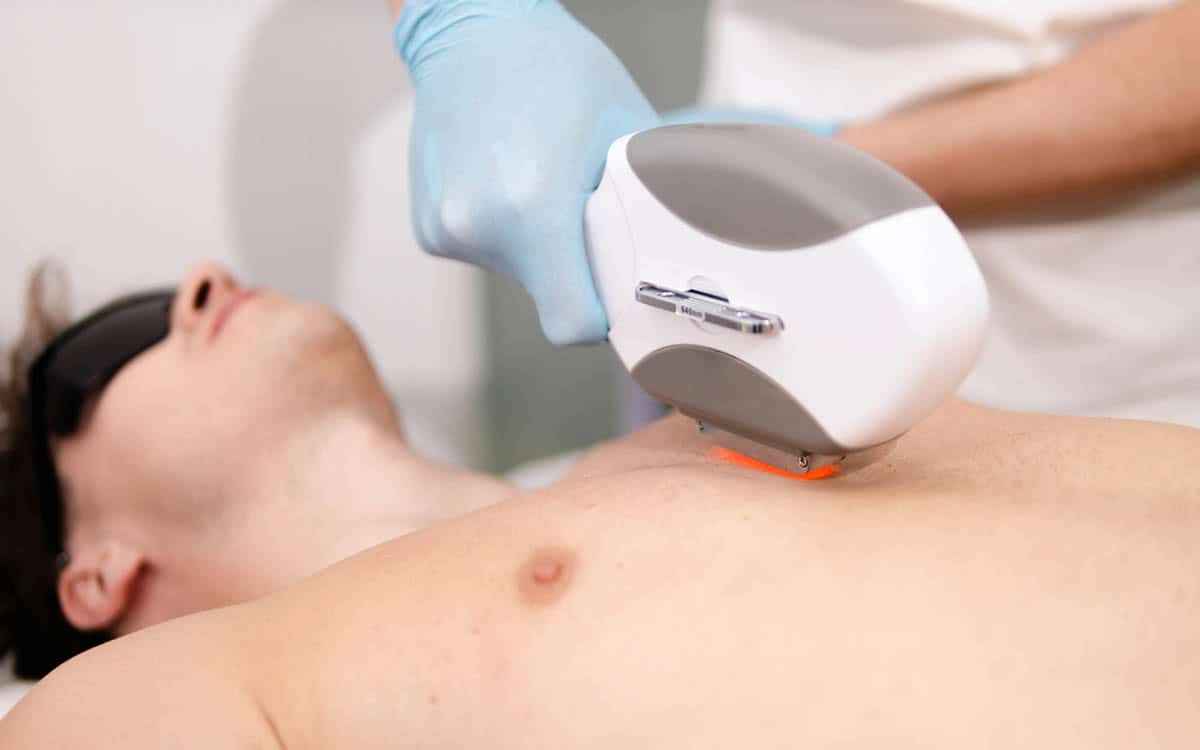 iniziare-epilazione-laser-dopo-estate-uomo